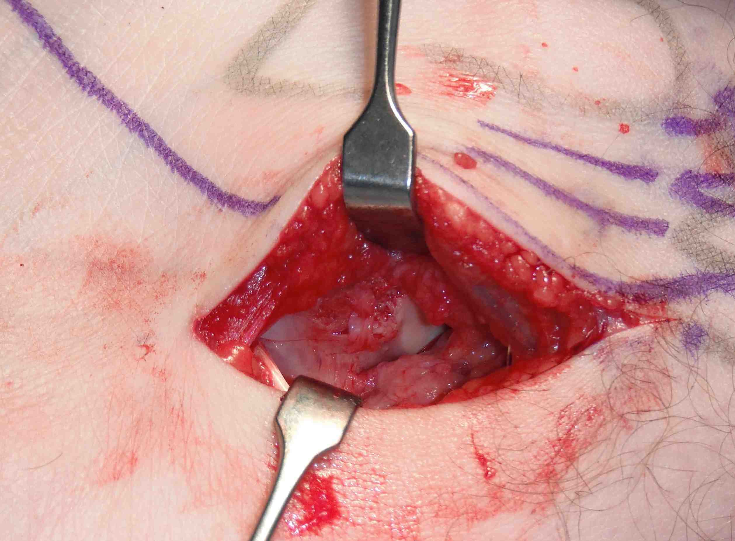Os Trigonum Posterior Talus Cartilage
